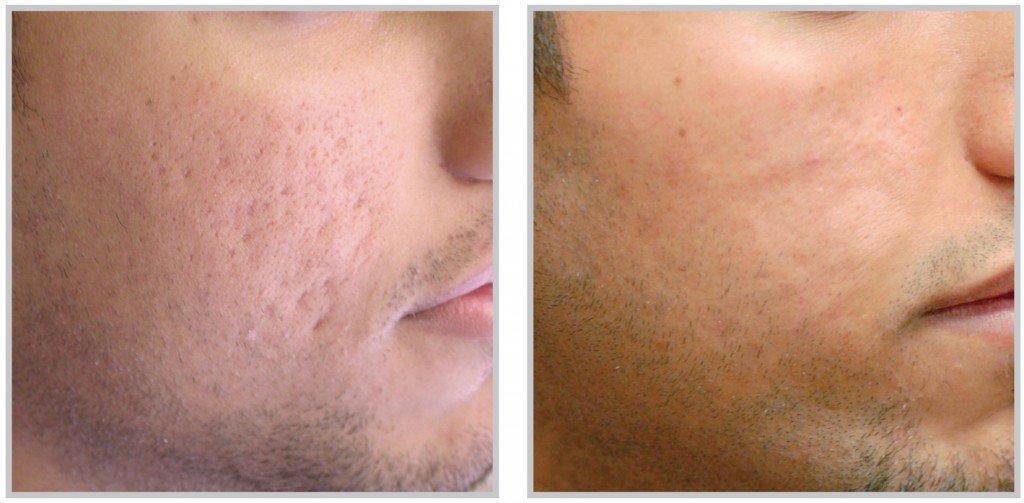 Acne-Scars-Image-PRP