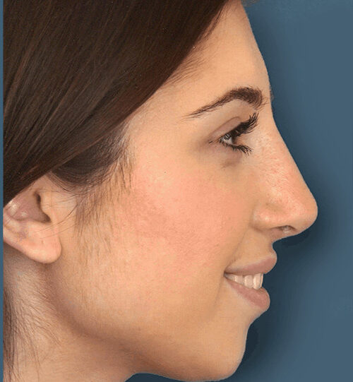 Why-Do-People-Prefer-Rhinoplasty-Surgery-in-India