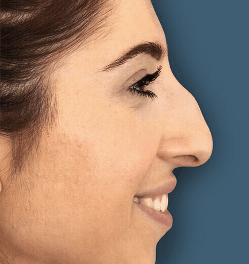 Why-Do-People-Prefer-Rhinoplasty-Surgery-in-India