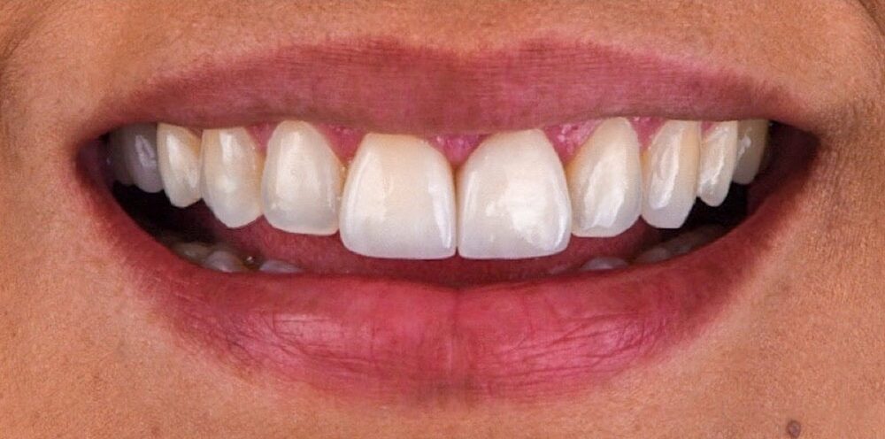 cosmetic-dentist-los-angeles-13-transformed