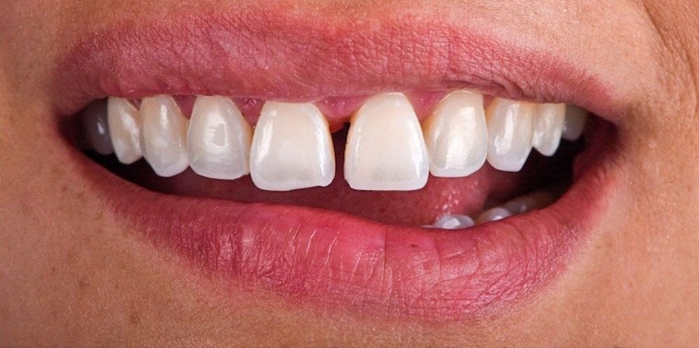 cosmetic-dentist-los-angeles-13-transformed