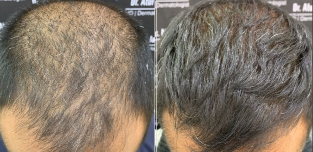 hair-loss-treatments-service-by-prp-dermaroller